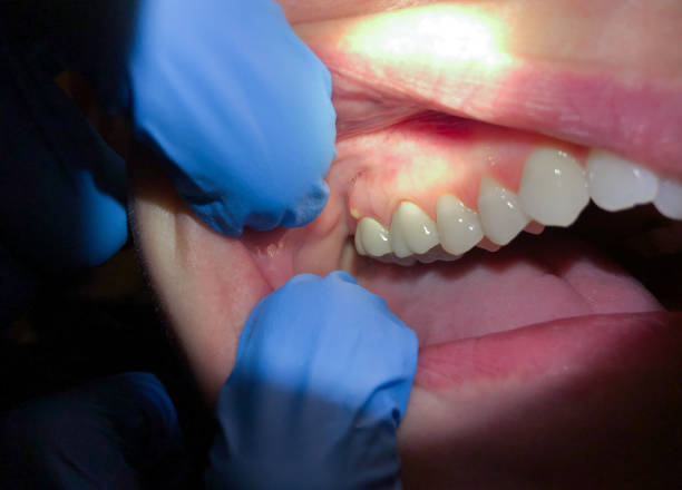 Best Emergency Dental Services for Seniors in Lake Waynoka, OH